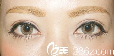 两个月前面诊了日本NOEL银座医院的保志名胜医生，从此有了欧美范的迷人大眼睛