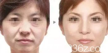 邯郸维多利亚双12优惠活动火热开启 注射爱芙莱玻尿酸和除皱针都只要980元