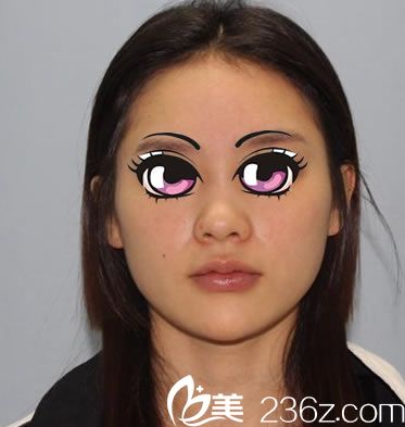 在宁波薇琳做歪鼻矫正之前 在宁波薇琳做歪鼻矫正之前