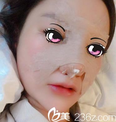 刚做完肋软骨鼻综合隆鼻照片 刚做完肋软骨鼻综合隆鼻照片