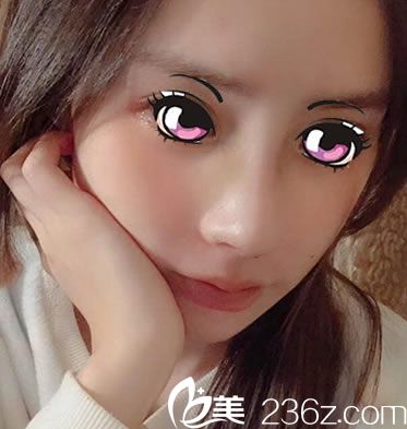 肋软骨鼻综合手术7天恢复照 肋软骨鼻综合手术7天恢复照