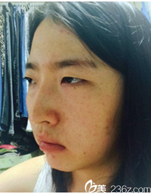 韩国新帝瑞娜医院做眼部+鼻部+脂肪填充+v-line术前 韩国新帝瑞娜医院做眼部+鼻部+脂肪填充+v-line术前