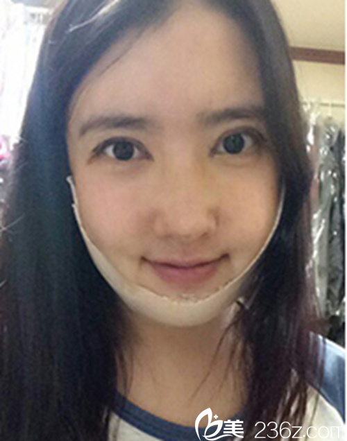 韩国新帝瑞娜医院做眼部+鼻部+脂肪填充+v-line术后一周后 韩国新帝瑞娜医院做眼部+鼻部+脂肪填充+v-line术后一周后