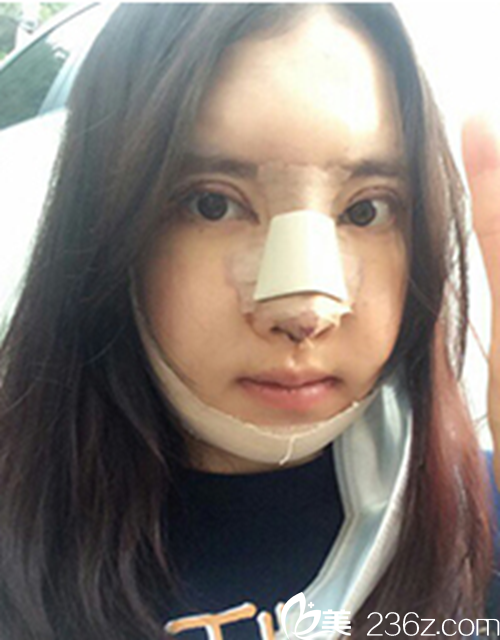韩国新帝瑞娜医院做眼部+鼻部+脂肪填充+v-line术后一周后