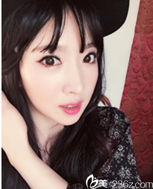 韩国新帝瑞娜医院做眼部+鼻部+脂肪填充+v-line术后1个月后 韩国新帝瑞娜医院做眼部+鼻部+脂肪填充+v-line术后1个月后