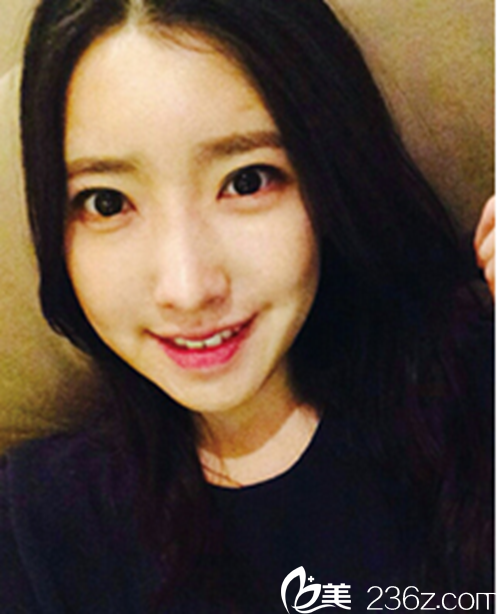 韩国新帝瑞娜医院做眼部+鼻部+脂肪填充+v-line术后1个月后 韩国新帝瑞娜医院做眼部+鼻部+脂肪填充+v-line术后1个月后