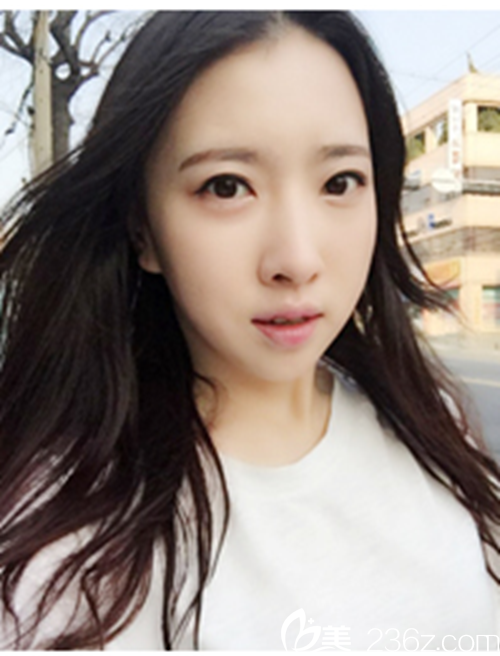 韩国新帝瑞娜医院做眼部+鼻部+脂肪填充+v-line术后6个月后 韩国新帝瑞娜医院做眼部+鼻部+脂肪填充+v-line术后6个月后