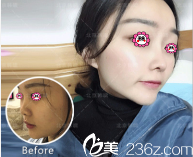 北京韩啸耳软骨复合隆鼻多少钱?韩啸整形隆鼻价格案例抢先看