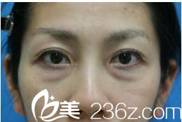 治疗前眼袋和松弛明显 治疗前眼袋和松弛明显