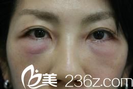 手术1天后 手术1天后