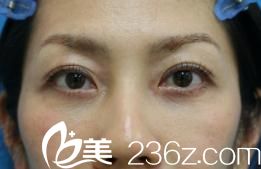 手术一个月左右 手术一个月左右