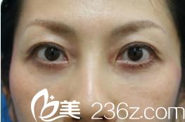 日本哪个医生擅长祛眼袋？找日本銀座CUVO医院久保隆之医生为我做了祛眼袋手术