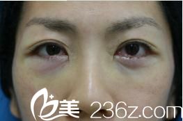 手术结束当天 手术结束当天