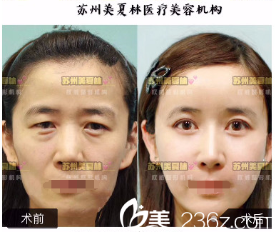 双12买买买不如到苏州美夏林整形变美 优惠项目价格表芭比眼综合4680元面部吸脂680元