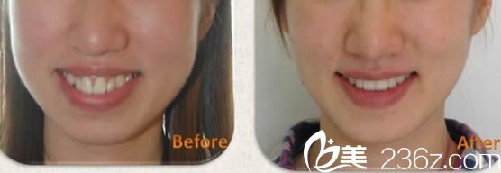 成人龅牙矫正案例及脸型变化图 成人龅牙矫正案例及脸型变化图