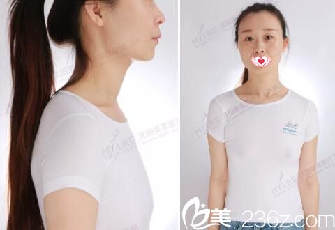 做圆形假体丰胸术前照 做圆形假体丰胸术前照