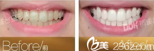 重庆铜雀台洁牙案例 重庆铜雀台洁牙案例