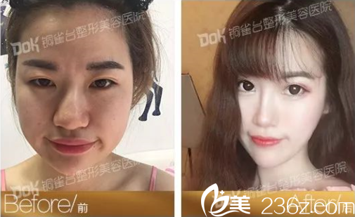 重庆铜雀台瘦脸效果怎么样 重庆铜雀台瘦脸效果怎么样