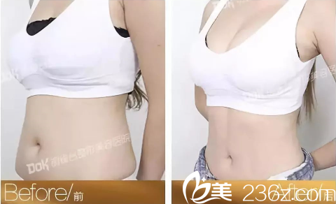 重庆铜雀台腰腹吸脂案例 重庆铜雀台腰腹吸脂案例