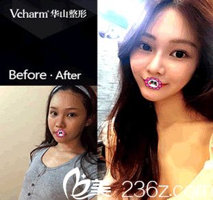 我在华山整形医院找胡斌院长做的双眼皮前后对比图