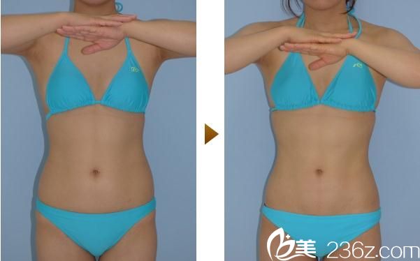 内浦康信腹部吸脂