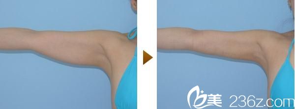 内浦康信手臂吸脂