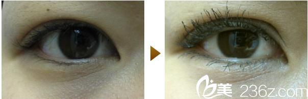 内浦康信双眼皮手术