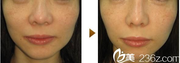 内浦康信鼻尖缩小术