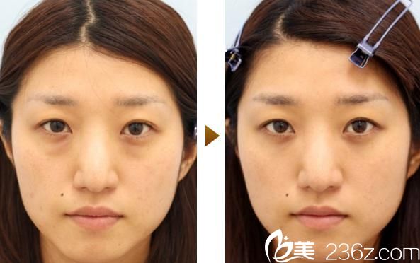 百泽明祛眼袋 百泽明祛眼袋