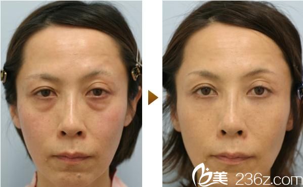 百泽明祛除眼部重度松弛 百泽明祛除眼部重度松弛