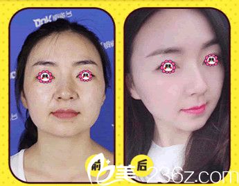 郑州医德佳整形医院面部提升案例
