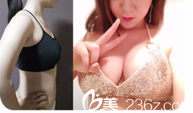 北京南加门诊部张清峰医生自体脂肪丰胸案例