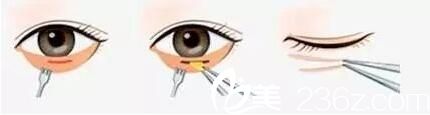 上海羡姿医疗美容外科诊所姜佩芳祛眼袋方法