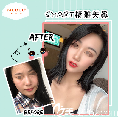 美贝尔隆鼻案例 美贝尔隆鼻案例