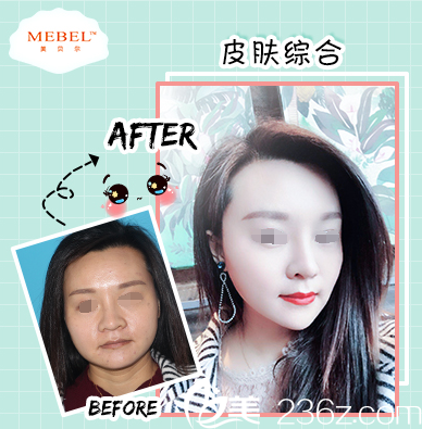 在苏州美贝尔做激光祛斑案例 在苏州美贝尔做激光祛斑案例