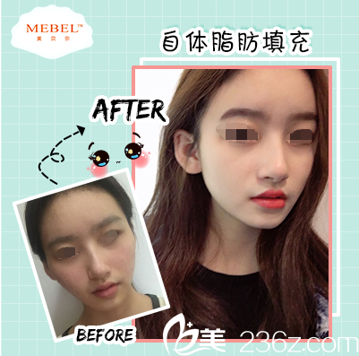 苏州美贝尔自体脂肪填充案例 苏州美贝尔自体脂肪填充案例