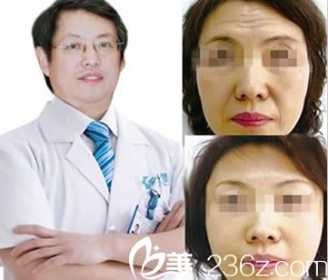 楚雄吴氏嘉美特邀医生王毅超爱贝芙案例（注射除皱）图