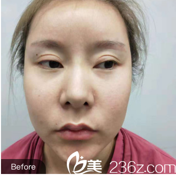 隆鼻术前照片 隆鼻术前照片