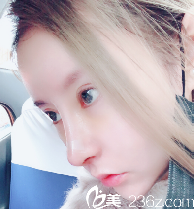 汕头华美朱洙玉隆鼻术后7天拆线图 汕头华美朱洙玉隆鼻术后7天拆线图