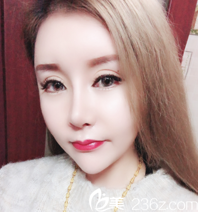 汕头华美朱洙玉做的鼻综合隆鼻案例 汕头华美朱洙玉做的鼻综合隆鼻案例