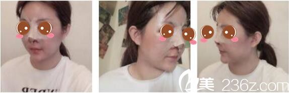 上海羡姿医疗美容外科诊所姜佩芳鼻综合术后第三天