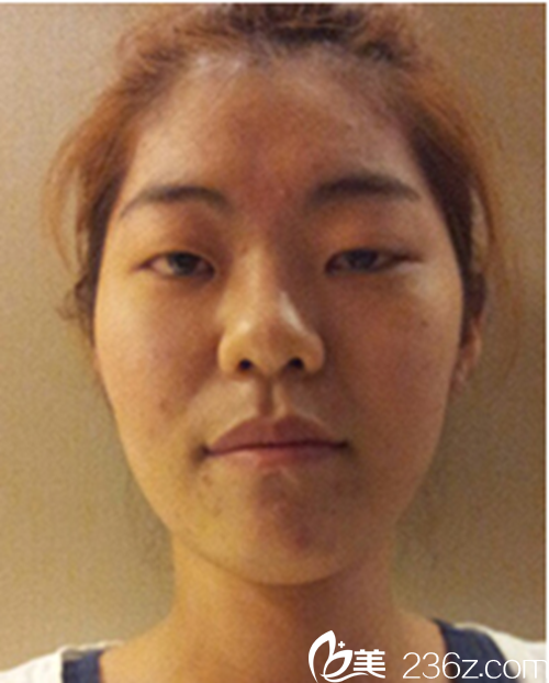 韩国新帝瑞娜医院眼部+鼻部+脂肪填充术前 韩国新帝瑞娜医院眼部+鼻部+脂肪填充术前