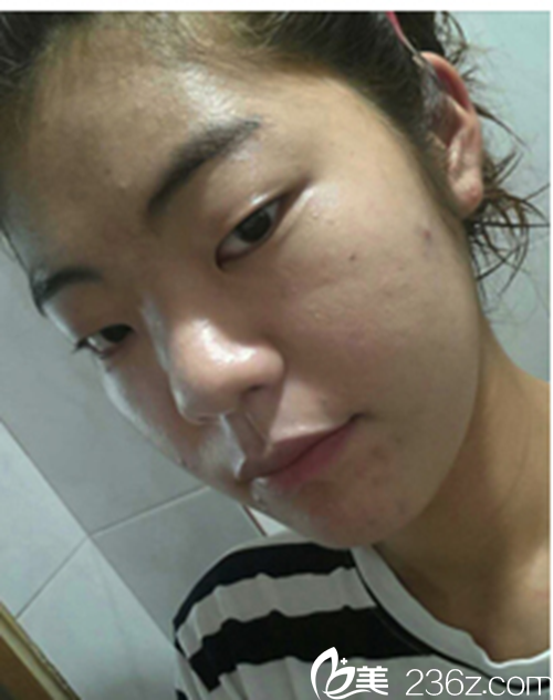 韩国新帝瑞娜医院眼部+鼻部+脂肪填充术前