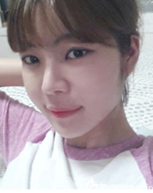 韩国新帝瑞娜医院眼部+鼻部+脂肪填充术后1个月后 韩国新帝瑞娜医院眼部+鼻部+脂肪填充术后1个月后