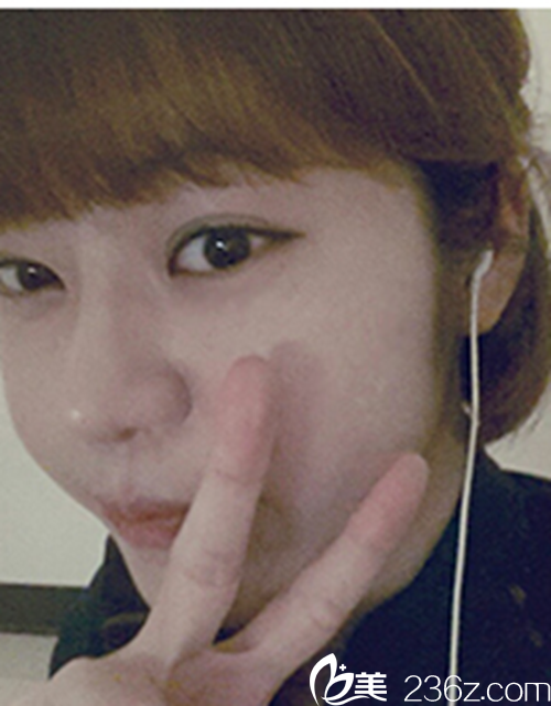 韩国新帝瑞娜医院眼部+鼻部+脂肪填充术后1个月后 韩国新帝瑞娜医院眼部+鼻部+脂肪填充术后1个月后