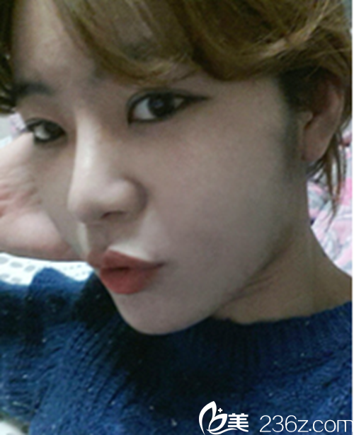 韩国新帝瑞娜医院眼部+鼻部+脂肪填充术后5个月后 韩国新帝瑞娜医院眼部+鼻部+脂肪填充术后5个月后