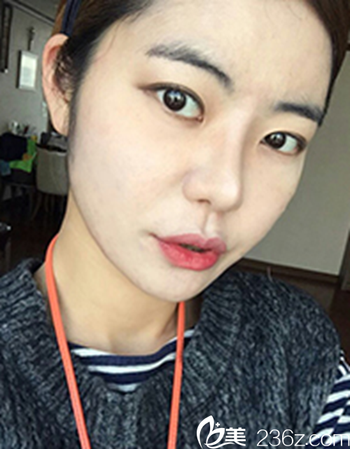 眼睛脱“单”我也脱单了，半年见证韩国新帝瑞娜医院的芭比混血美眸