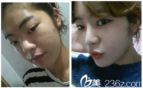韩国新帝瑞娜医院眼部+鼻部+脂肪填充术前术后对比图 韩国新帝瑞娜医院眼部+鼻部+脂肪填充术前术后对比图