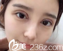 现在的眼睛虽然宽但是整形