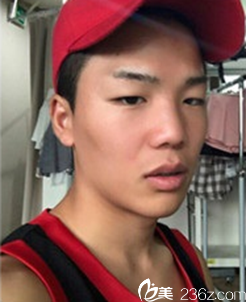 韩国新帝瑞娜医院鼻部+眼睛矫正术前 韩国新帝瑞娜医院鼻部+眼睛矫正术前